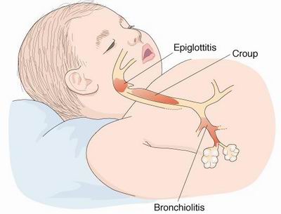 Croup is a respiratory disorder that normally occurs in the children in the 