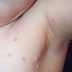 Children and Warts