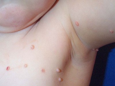 common wart images. Children keep on getting warts