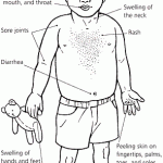 Kawasaki Disease Symptoms In Children