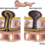 Spina Bifida