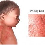 Different Types of Common Baby Skin Rashes