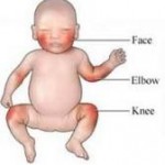 Infant Eczema Causes, Symptoms and Treatment