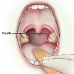 Symptoms of Tonsillitis in Babies or Infants