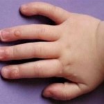 Different Types of Warts on Children